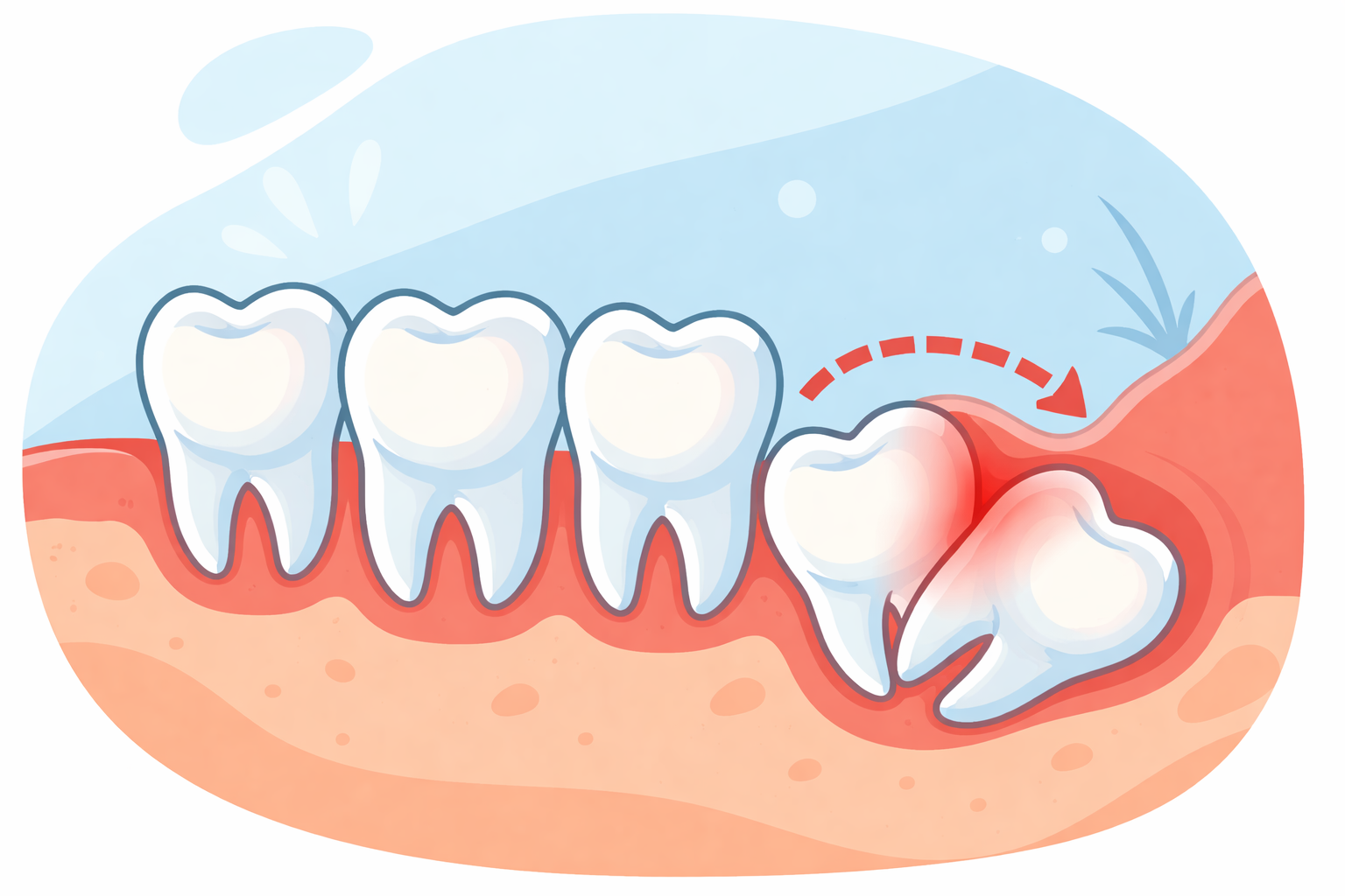 Featured image for Do Wisdom Teeth Cause Crooked Teeth?
