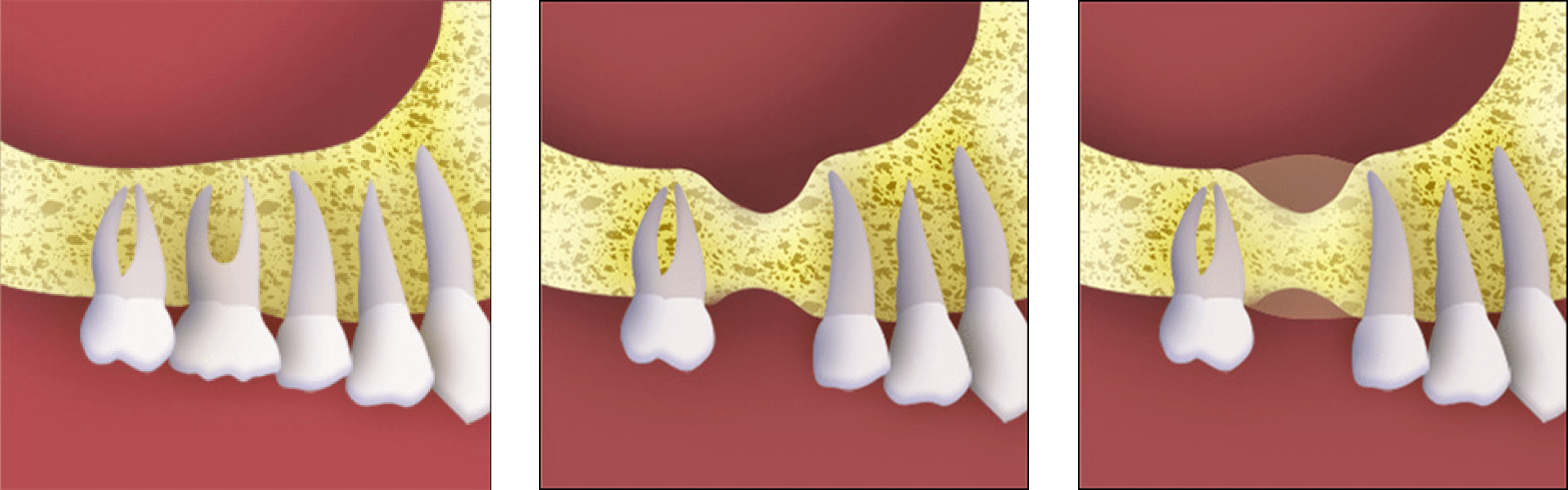 bone-grafting bone-grafting