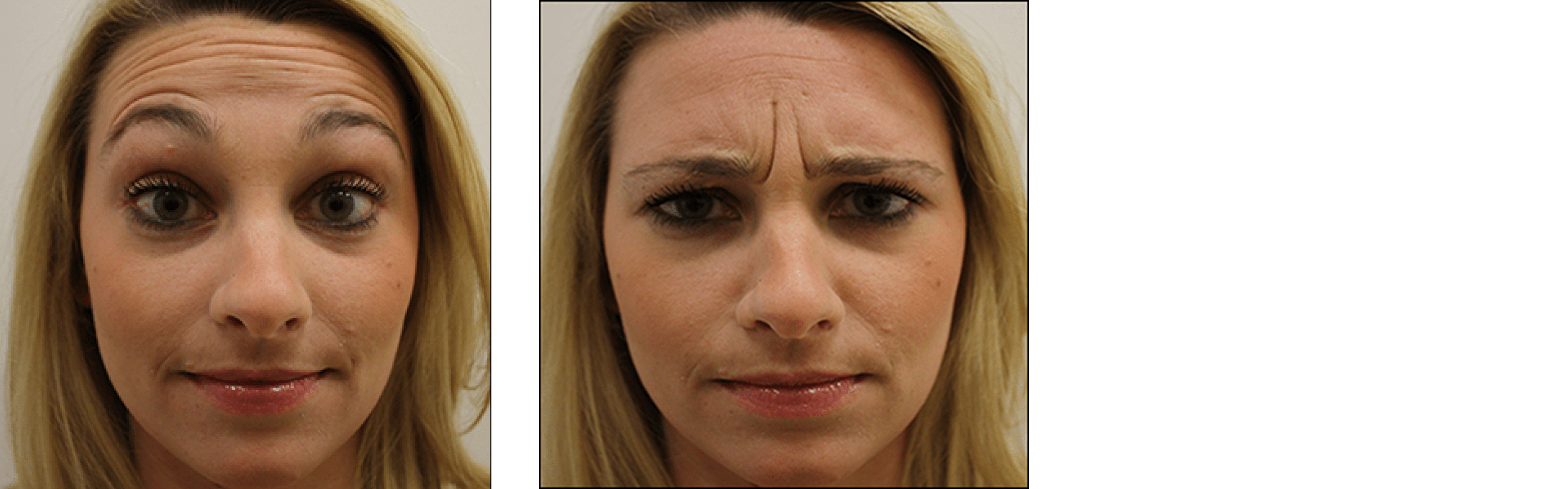 botox botox