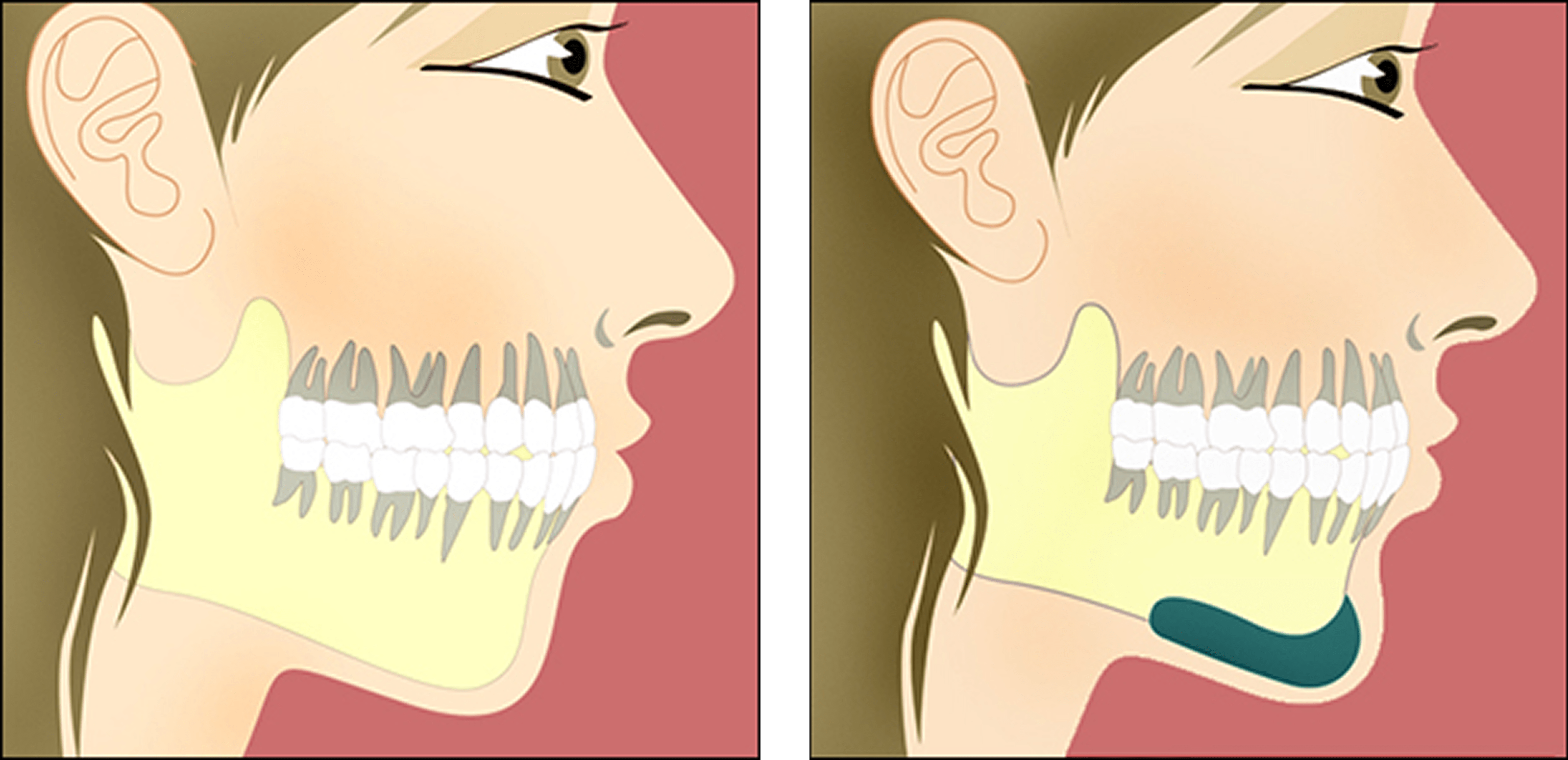 Facial Implants cheek chin Facial Implants cheek chin