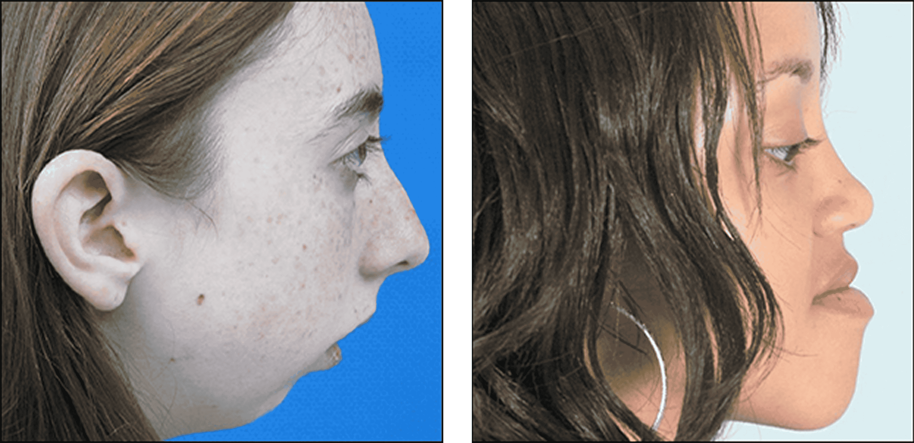 Chin Surgery Chin Surgery